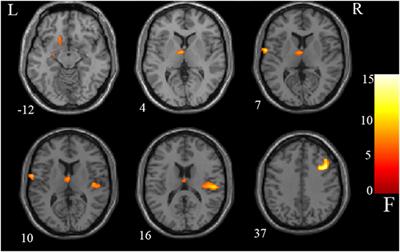 Decreased Left Putamen and Thalamus Volume Correlates with Delusions in First-Episode Schizophrenia Patients